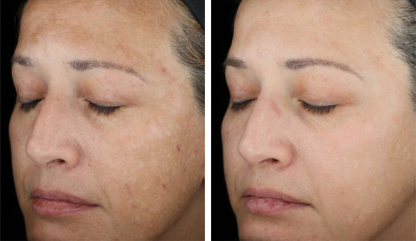 skinmedica tns recovery complex before and after