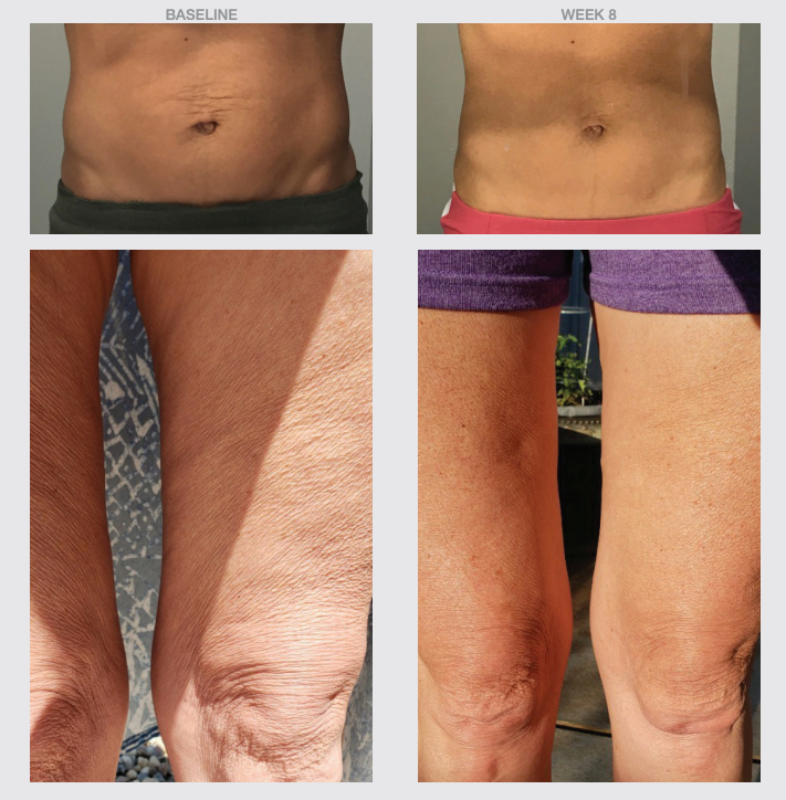 Knee and abdomen skin before and after 8 weeks of Smooth Body Firming Lotion, displaying smoother texture and toned appearance