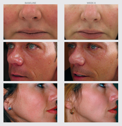 Before and after 8 weeks using Triple AntiOx Resveratrol Cream, showing reduced facial wrinkles and improved skin tone