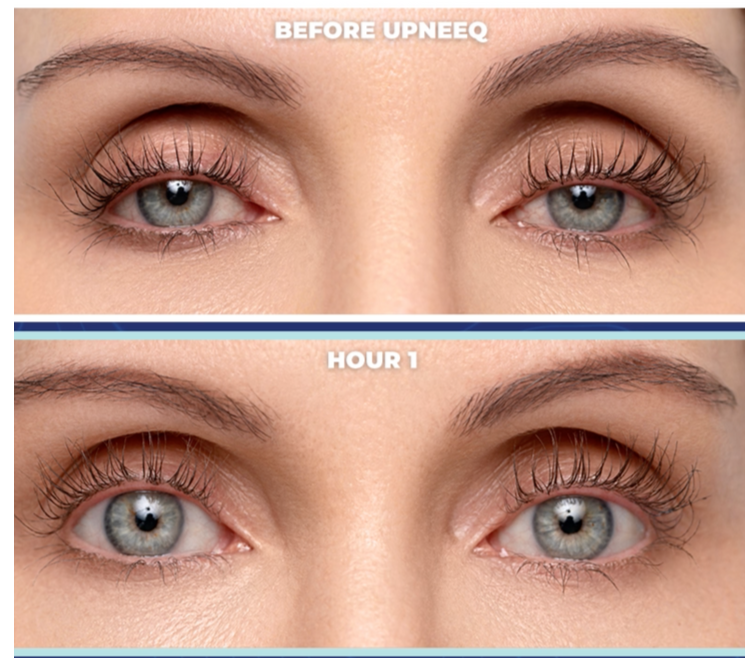 Before and after of UPNEEQ Eye Opening Drops showing lifted eyelids and more open eyes at hour 1 after application