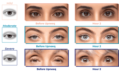 Before and after of UPNEEQ Eye Opening Drops showing lifted eyelids at hour 2 in mild, moderate, and severe ptosis cases