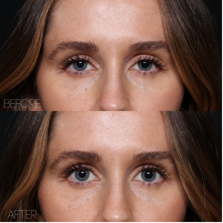 Before and after of UPNEEQ Eye Opening Drops showing lifted eyelids and a more open eye appearance