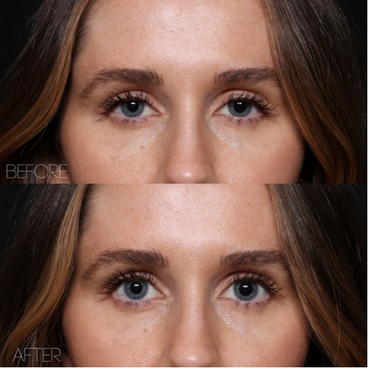 Before and after of UPNEEQ Eye Opening Drops showing lifted eyelids and a more open eye appearance